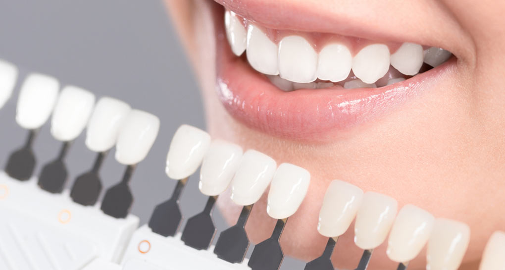 Ультратонкие виниры